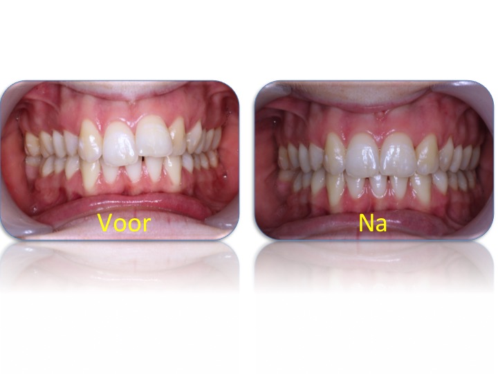 Missend Autonoom limiet Invisalign onzichtbare beugel– Roelofs Orthodontistenpraktijk